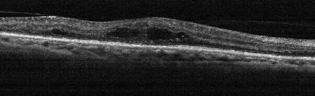 edema macular diabetico